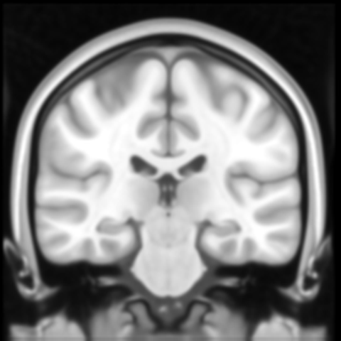 Coronal brain MRI